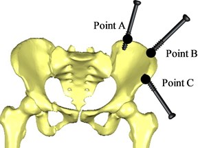 Position of bone traction needle inserted into the pelvic