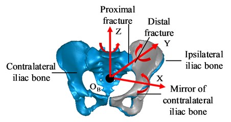 Mirror-image healthy side registration  model of pelvic fracture