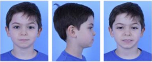 a) Extraoral photographs (T0), b) and c) intraoral photographs (T0), and  d) orthopantomogram (T0); T0 refers to the pre-treatment stage