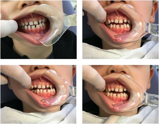 Planas direct tracks installed in the occlusal surface of the upper and lower deciduous molars