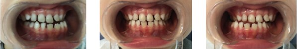 a) Resin-composite planas direct tracks bonded directly to anterior teeth;  b) Simões Network 3 (SN3) appliances with Bimler’s upper dental arch;  c) Second resin-composite planas direct tracks bonded to teeth #63 and #53