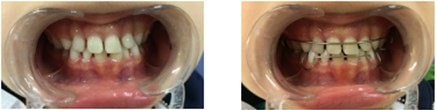 a) Resin-composite planas direct tracks bonded directly to anterior teeth;  b) Simões Network 3 (SN3) appliances with Bimler’s upper dental arch;  c) Second resin-composite planas direct tracks bonded to teeth #63 and #53