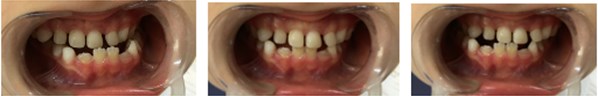 a) Resin-composite planas direct tracks bonded directly to anterior teeth;  b) Simões Network 3 (SN3) appliances with Bimler’s upper dental arch;  c) Second resin-composite planas direct tracks bonded to teeth #63 and #53