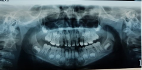 a) Extraoral photographs (T1), b) intraoral photographs (T1), and c) orthopantomogram (T1);  T1 refers to the treatment stage after a one-year follow-up