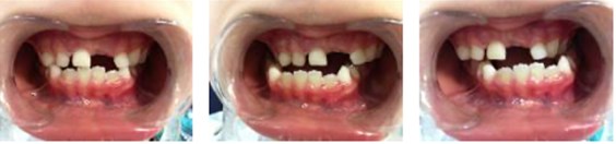 Patient with second SN3 oral appliances and intraoral photographs after one-year follow-up