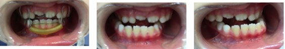 Patient with second SN3 oral appliances and intraoral photographs after one-year follow-up