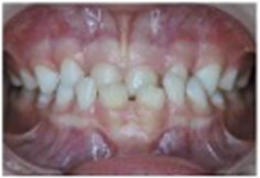 a) Extraoral photographs (T0), b) and c) intraoral photographs (T0), and  d) orthopantomogram (T0); T0 refers to the pre-treatment stage