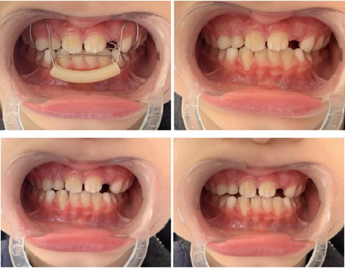 Extraoral photographs (T2); T2 refers to the post-treatment stage