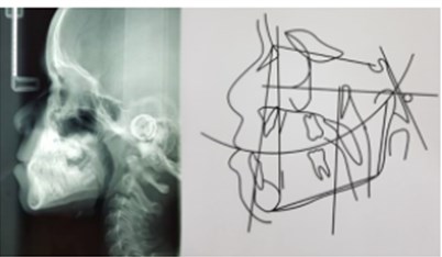 a) Lateral teleradiograph and cephalometric analysis in 2017; b) lateral teleradiograph and cephalometric analysis in 2018; c) lateral teleradiograph and cephalometric analysis in 2019