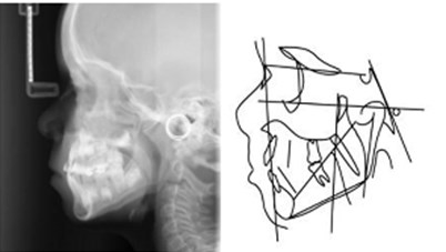 a) Lateral teleradiograph and cephalometric analysis in 2017; b) lateral teleradiograph and cephalometric analysis in 2018; c) lateral teleradiograph and cephalometric analysis in 2019