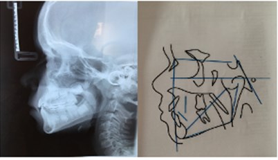 a) Lateral teleradiograph and cephalometric analysis in 2017; b) lateral teleradiograph and cephalometric analysis in 2018; c) lateral teleradiograph and cephalometric analysis in 2019