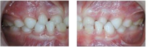 a) Extraoral photographs (T0), b) and c) intraoral photographs (T0), and  d) orthopantomogram (T0); T0 refers to the pre-treatment stage