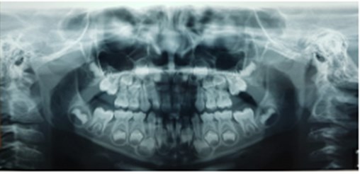 a) Extraoral photographs (T0), b) and c) intraoral photographs (T0), and  d) orthopantomogram (T0); T0 refers to the pre-treatment stage