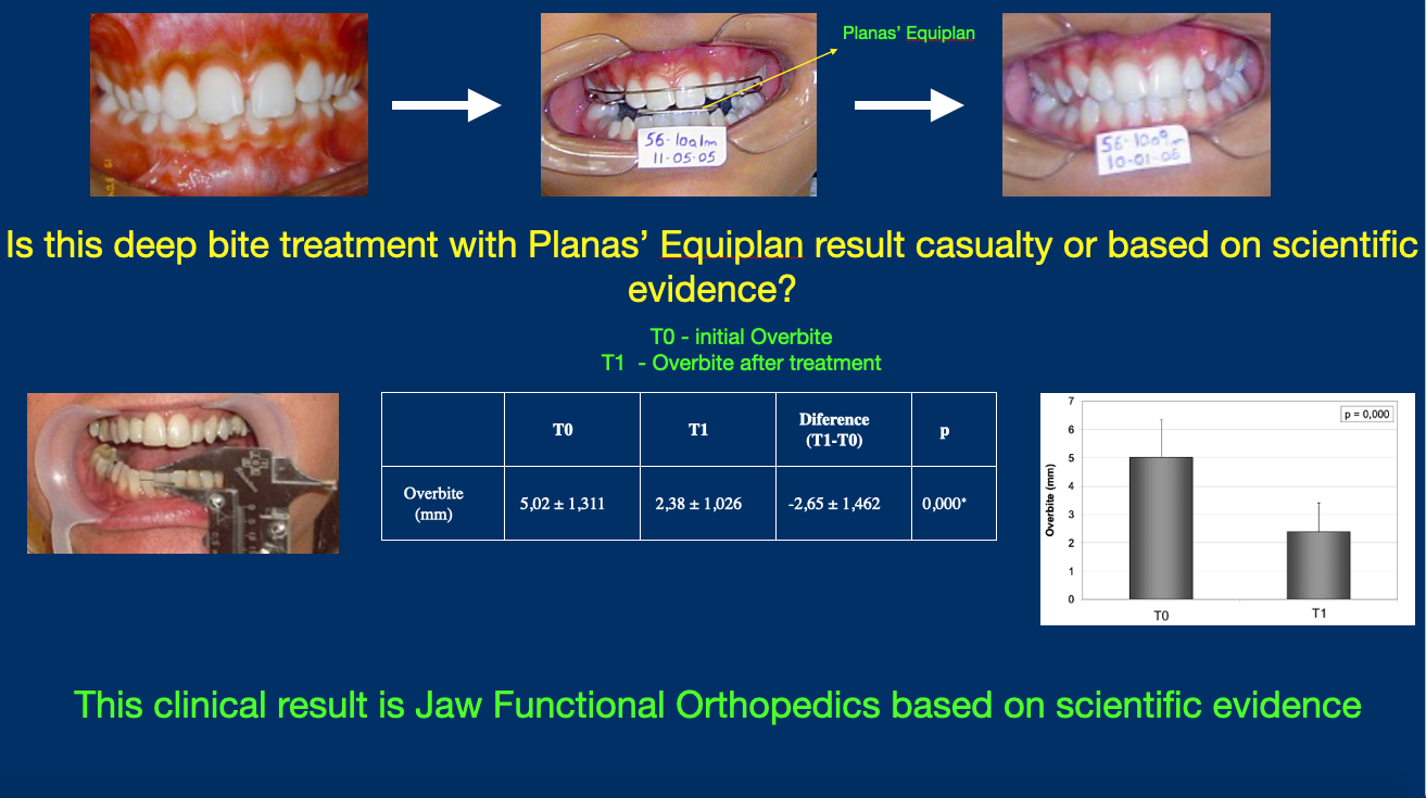 Does Planas’ Equiplan really work in deep bite treatment?