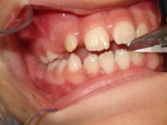 Overbite without incisor trespass, measured with a pachymeter