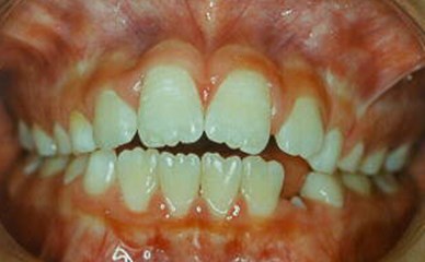 Examples of improvement in overbite with JFO treatment. a) Patient M.E.P. prior to treatment, b) result after 16 months of use of FOA with total closure of the open bite. c) Patient D.O.R. prior to treatment and d) after 18 months of use of FOA with partial closure of the open bite