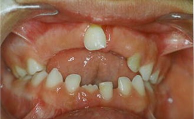 Examples of improvement in overbite with JFO treatment. a) Patient M.E.P. prior to treatment, b) result after 16 months of use of FOA with total closure of the open bite. c) Patient D.O.R. prior to treatment and d) after 18 months of use of FOA with partial closure of the open bite