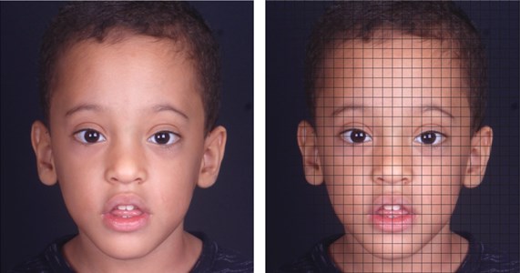 Asymmetrical face: left hemiface wider than the right hemiface; left ear lower than the right ear  and directed more forward in relation to the left ear; left eye lower than the right eye