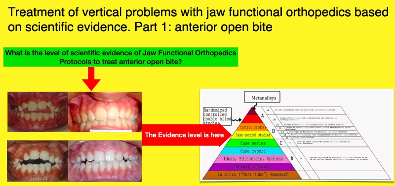 Treatment of vertical problems with jaw functional orthopedics based on scientific evidence. Part 1: anterior open bite