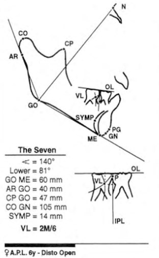 Articular Compass cephalometric structural analysis. Figure Extracted from Simões [10]