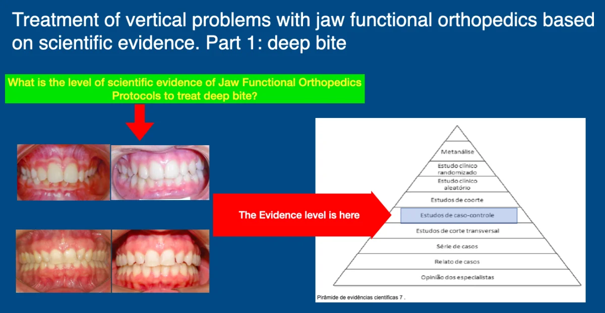 Treatment of vertical problems with jaw functional orthopedics based on scientific evidence. Part 2: deep bite