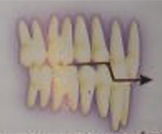 Deckbiss occlusal plane. Figure extracted from Simões [6]
