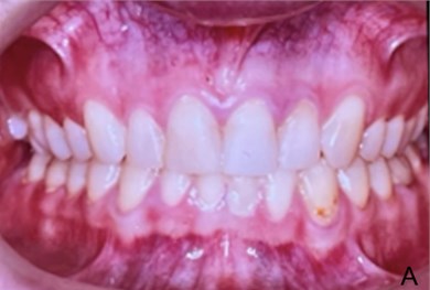 a) DB can be observed; b) patient with the FOA (in this case a OSS3) with a mandibular posture change stimulating the vertical growth of posterior teeth alveolar bone to correct the DB and mandibular posture change with frontal blocker to correction mandibular deviation