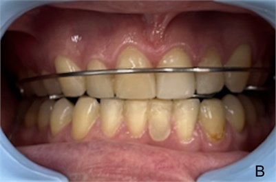 a) DB can be observed; b) patient with the FOA (in this case a OSS3) with a mandibular posture change stimulating the vertical growth of posterior teeth alveolar bone to correct the DB and mandibular posture change with frontal blocker to correction mandibular deviation