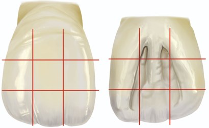 The dental crown can be divided in 9 receptive fields. We must consider on a vertical division,  the establishment of a mesial third, a medium third and a distal third. Considering a horizontal division,  we will have a cervical third, a medium third and an incisal third