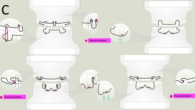 DHC arch designs. Observe that in all panels, the star shows the dental  neural excitation respecting the crown topography