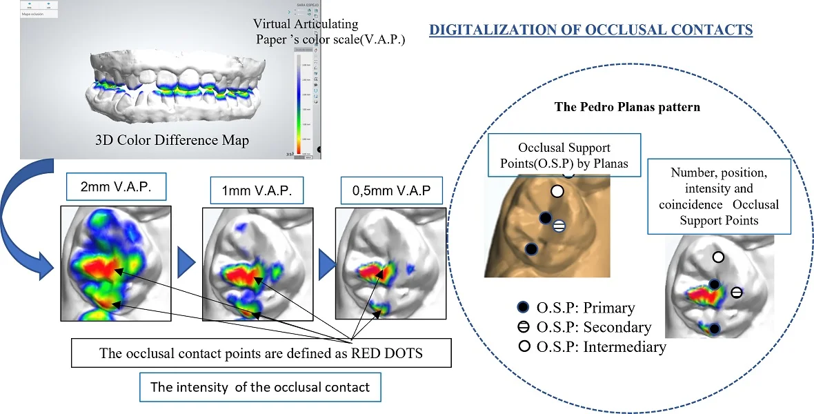 Clinical application of digitalization of occlusal contacts with dental scanner