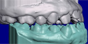 STL models generated by the first intraoral scan