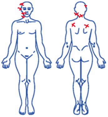 Most frequent location of the pain, as marked by the test subjects on the McGill questionnaire