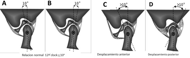 a), b) Position 12 o’clock. Disk ratio (posterior band junction with bilaminar zone)  with mandibular condyle with deviation of ±10°; c) anterior displacement of the disc;  d) posterior displacement of the disc [3]
