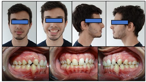 Occlusal changes obtained with Planas’ indirect composite tracks. JOF treatment