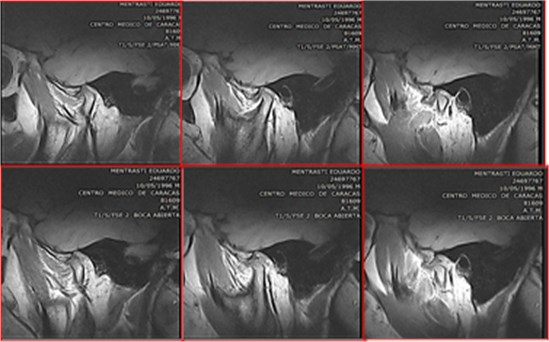 Magnetic Resonance Image sagittal section of the left TMJ, (upper image) mouth closed anterior displacement of the disc; (lower image) Mouth open, disc displacement with reduction.  The disc is recaptured during the mouth opening movement