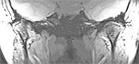 Coronal section Magnetic Resonance Image, in closed mouth position.  Medial disc displacement. The right TMJ is more evident than the left