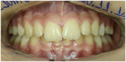 Initial front view of malocclusion