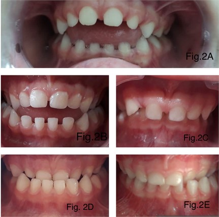 Types of malocclusion classified: 2A (anterior open bite) 2B (anterior open bite alongside posterior crossbite), 2C (deep bite), 2D (anterior crossbite), 2E (posterior crossbite)