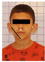 Assessment of mandibular displacement amplitude in centralized posture and in right and left lateralization: a) mandible lateralized to the right, b) centered jaw, c) mandible lateralized to the left