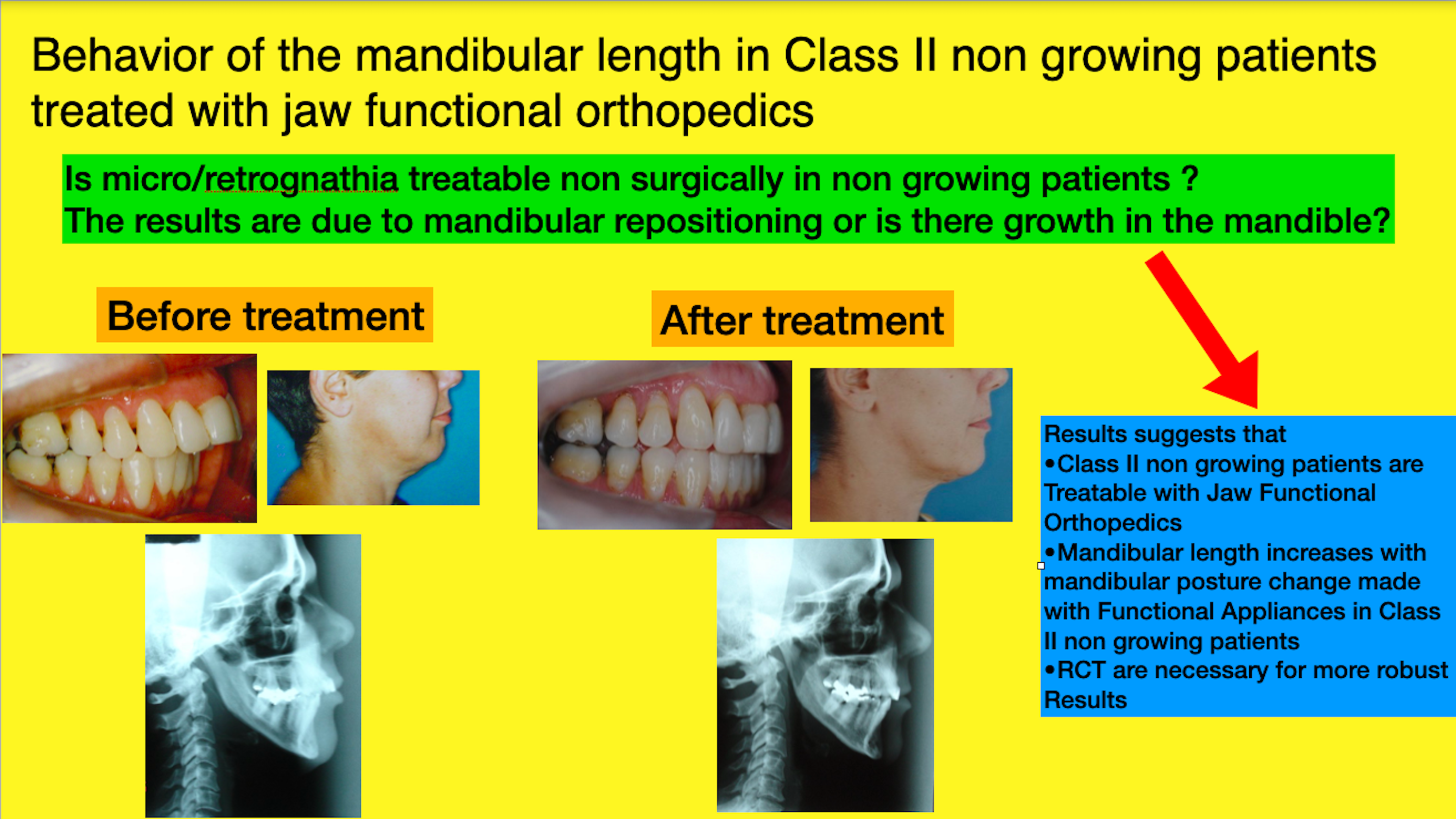 Behavior of the mandibular length in class II non-growing patients treated with jaw functional orthopedics
