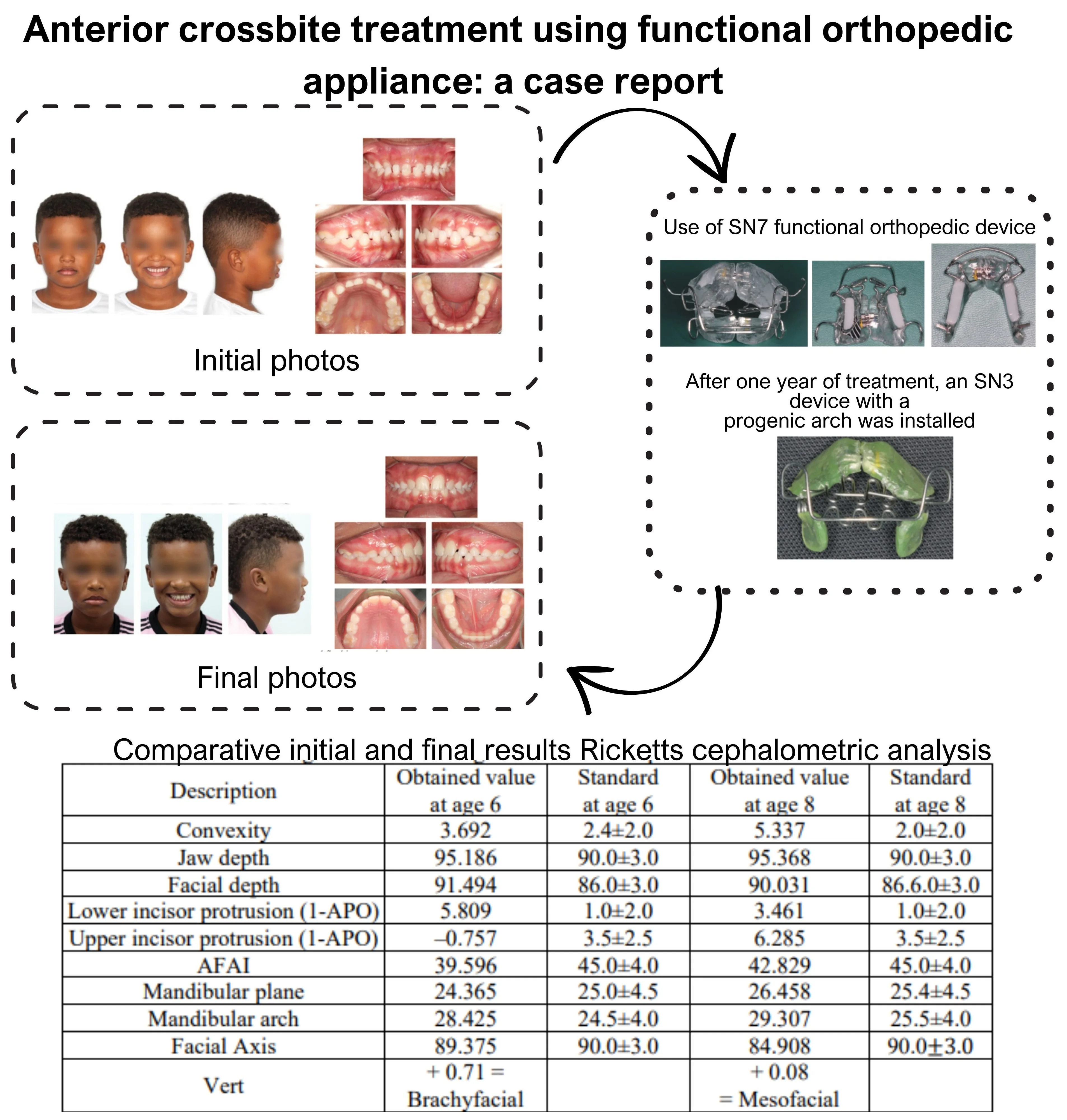 Anterior crossbite treatment using functional orthopedic appliance: a case report