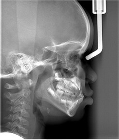 Initial lateral cephalometric radiograph