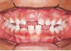 Occlusal interferences: a) interference in centric occlusion; b) carbon marks of the interferences;  c) carbon marks of the interferences; d) carbon marks of the interferences;  e) wear for removal of the interference
