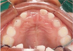 Occlusal interferences: a) interference in centric occlusion; b) carbon marks of the interferences;  c) carbon marks of the interferences; d) carbon marks of the interferences;  e) wear for removal of the interference