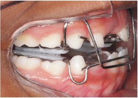 Adapted SN7 brace: a) frontal intraoral photo with SN7;  b) right lateral intraoral photo with SN7; c) left lateral intraoral photo with SN7;  d) upper occlusal intraoral photo with SN7; e) lower occlusal intraoral photo with SN7