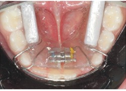 Adapted SN7 brace: a) frontal intraoral photo with SN7;  b) right lateral intraoral photo with SN7; c) left lateral intraoral photo with SN7;  d) upper occlusal intraoral photo with SN7; e) lower occlusal intraoral photo with SN7