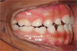 Intraoral photos six months after the start of treatment:  a) right intraoral photo; b) front intraoral photo; c) left intraoral photo