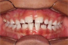 Intraoral photos six months after the start of treatment:  a) right intraoral photo; b) front intraoral photo; c) left intraoral photo
