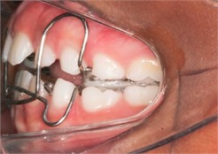Intraoral photos with SN7 eight months after the start of treatment: a) frontal intraoral photo;  b) right lateral intraoral photo; c) left lateral intraoral photo;  d) occlusal superior intraoral photo; e) occlusal inferior intraoral photo